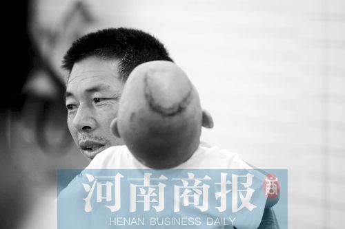 两个孙子手术成功,史留柱松了口气