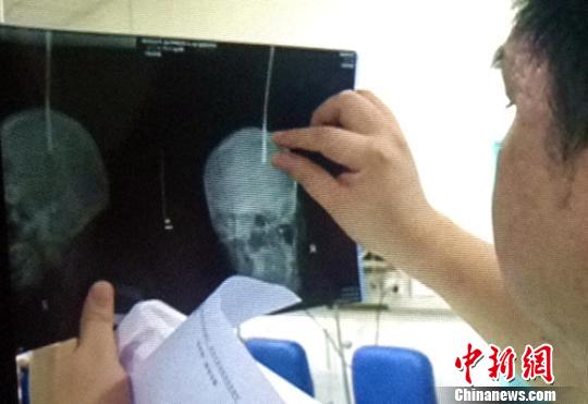 钢筋插入工友头部太深,受伤工人已出现偏瘫迹象。 刘俊 摄