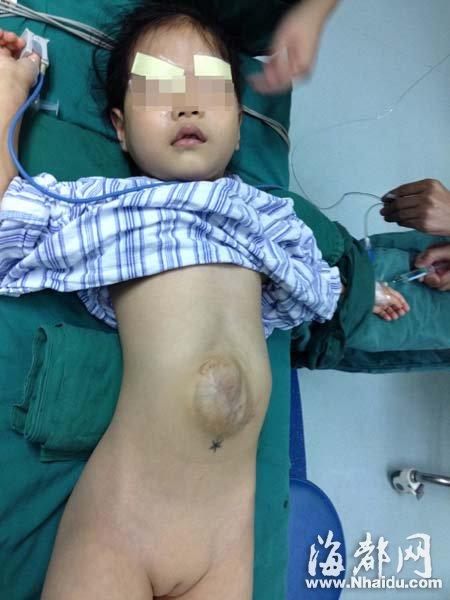 女童先天五脏六腑裸露 做3次手术成功修复(图)