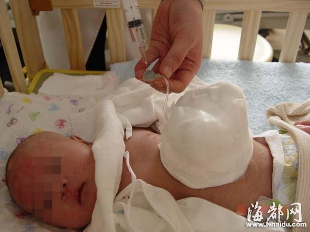 女童先天五脏六腑裸露 做3次手术成功修复(图)