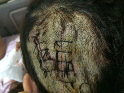 近日，演员李依晓在横店发生意外事故，被送往医院时已经是满身的血迹，头部和耳朵伤口缝线多达二十余针，而为了缝合伤口有一部分头发被剃光。
