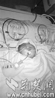 天降水泥块砸中40天女婴 2次手术仍未脱险(图)