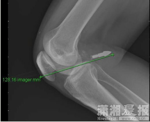 箭头射进膝盖内，留在外面的箭身足有70—80CM长。图潇湘晨报通讯员 汤雪.jpg