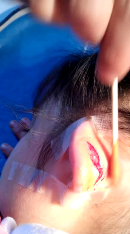 7岁女童因答问题声小被老师扯烂耳朵