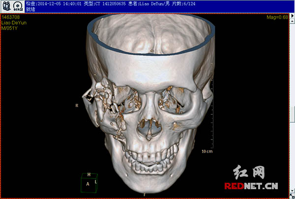交通事故致面部严重创伤 3D打印技术为伤者补