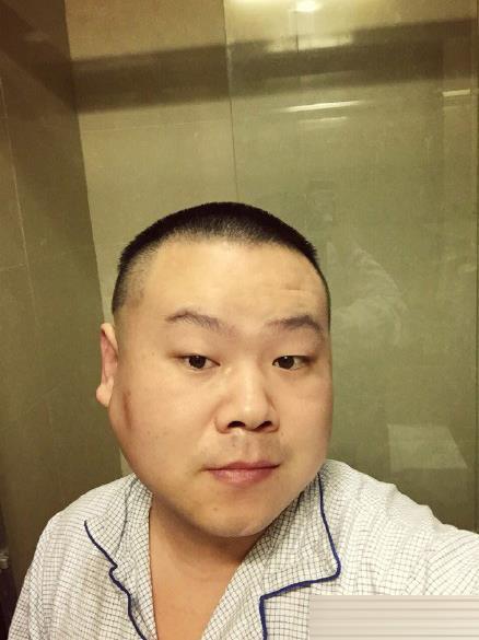 岳云鹏切除面部肿瘤