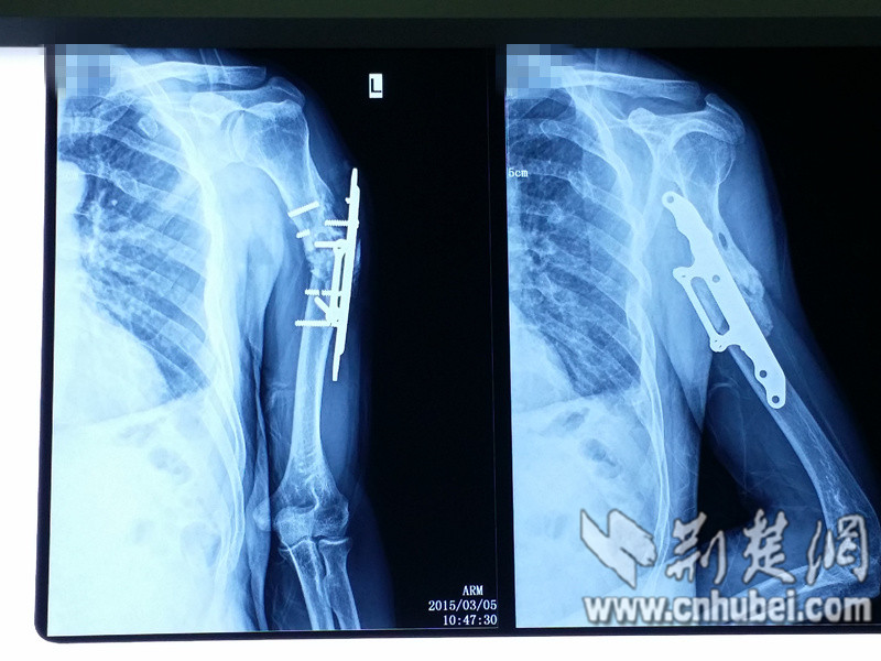 荆楚网消息（通讯员 杨敬慈 王皓）现年53岁的赵先生于1994年因车祸撞断左臂，送医上钢板后，他并未过分在意，为了生计，一个月后便又投入体力工作，提拿重物。约半年左右，他左臂伤口处皮肤出现一个小凸起，一摸竟然是硬的，好像是上的钢板的一端，不过上臂还是能活动的，他便不管不顾拖着不太灵活的手继续勤勉地工作，也没有及时到医院就诊。