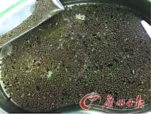 男子腰痛2年医生从其右肾取出千颗结石（图）