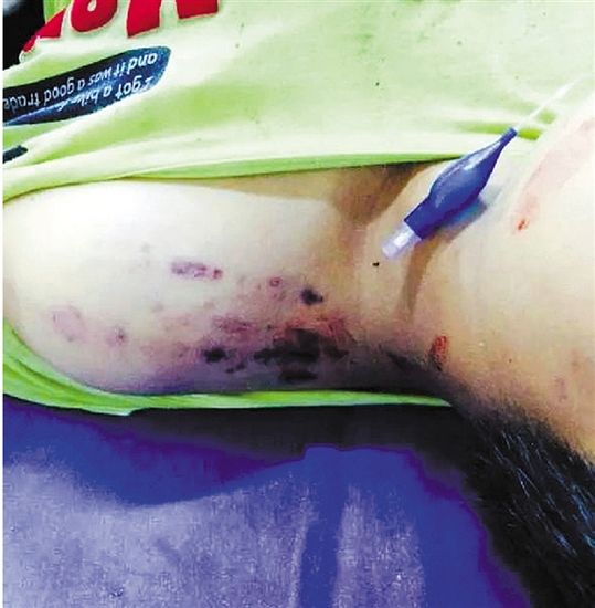 10岁男孩放学路上遭雷击身亡或因骑车招致电击