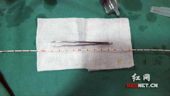 永州男子把金属眉钳塞入尿道辗转一个月后手术取出