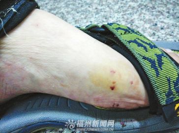男子上班途中踩中大老鼠被其狠咬一口受伤（图）