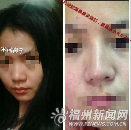 妙龄女整容后鼻孔一大一小医院称无法修复（图）