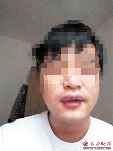 廖先生的上嘴唇仍未消肿。均为长沙晚报记者 朱炎皇 实习生 丁云凤 摄影报道