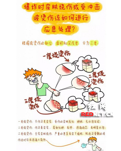 中南大学女生漫画爆炸后的三度烧烫伤。