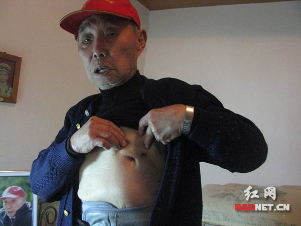 周敏文老人在淞沪会战中左胸中弹留下的伤疤。