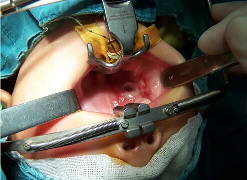 幼童拿电池学大人嗑瓜子 嘴巴被炸出血洞(图)