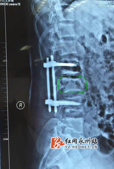 螺钉撑起压坏的脊梁 市中心医院脊柱外科微创
