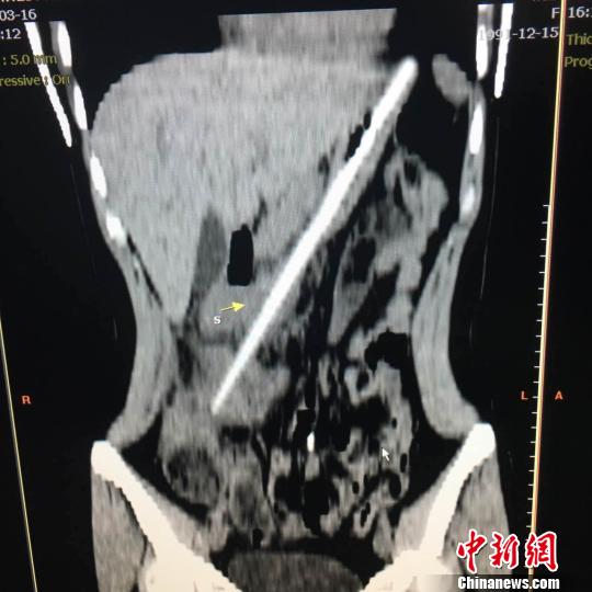 CT图可以清晰的看到筷子在唐唐腹中的样子。　肖瑶摄