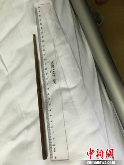 医生取出后的筷子。　肖瑶摄