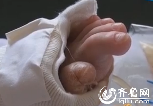 男孩的脚曾经被自己拿剪刀剪过。（视频截图）