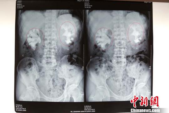 钟大爷的第一次DR（数字放射成像）检查结果，图中像“生姜”的即患者的巨大肾结石。 陈松 摄