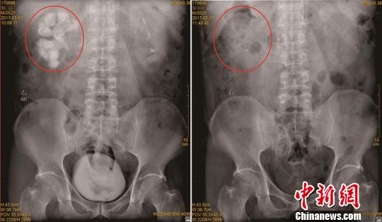邹先生手术前与第5次术后X光片对比图。左侧红圈中白色轮廓为结石，右侧为取净结石后的右肾。_　陈松　摄