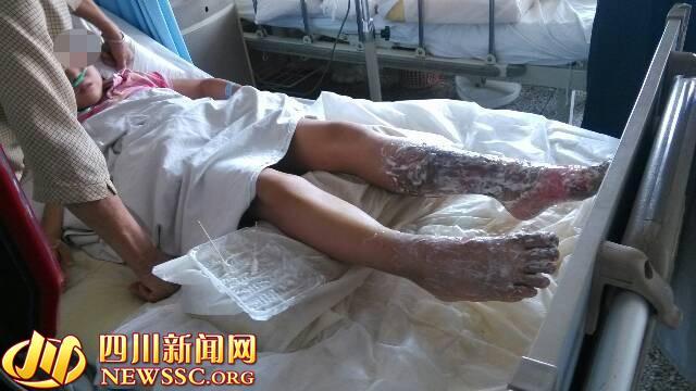 市民点蚊香引燃沙发 10岁女孩被烧伤(图)