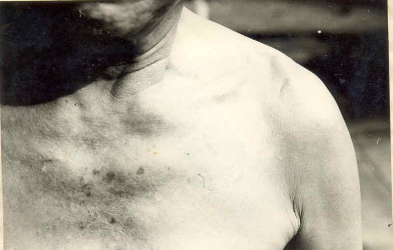 图为南京大屠杀幸存者查富奎(胸前的刀伤)